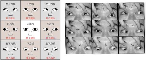 馬竇氏鏡|[問題] 雙眼眼球震顫+內斜(眼位不正)